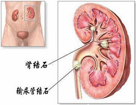 肾结石饮食